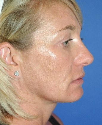 After Image: Eye Lift (Blepharoplasty): Case 14 - right-side