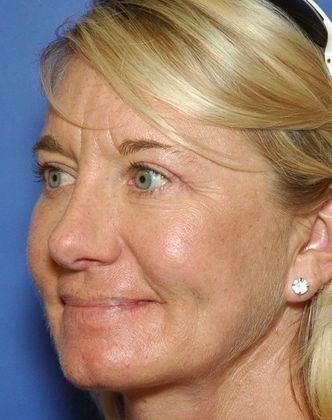 After Image: Eye Lift (Blepharoplasty): Case 14 - left-front-oblique