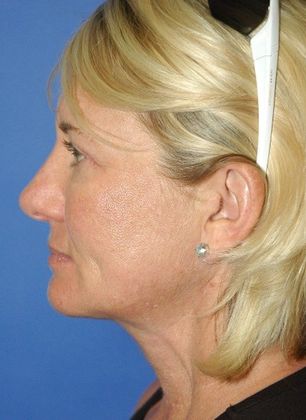 After Image: Eye Lift (Blepharoplasty): Case 14 - left-side