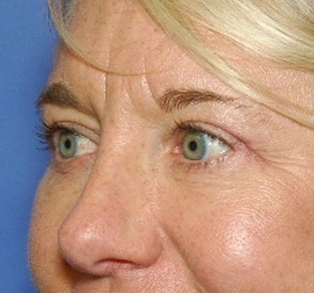 After Image: Eye Lift (Blepharoplasty): Case 14 - left-front-oblique