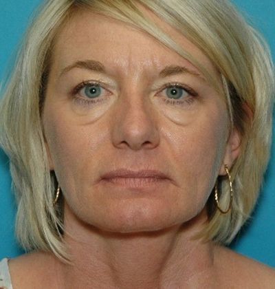 Before Image: Eye Lift (Blepharoplasty): Case 14 - front