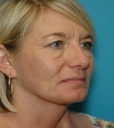 Before Image: Eye Lift (Blepharoplasty): Case 14 - right-front-oblique