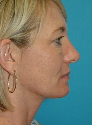 Before Image: Eye Lift (Blepharoplasty): Case 14 - right-side