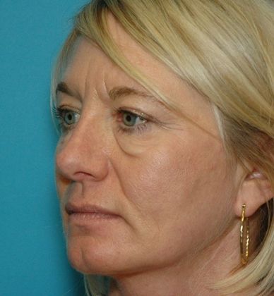 Before Image: Eye Lift (Blepharoplasty): Case 14 - left-front-oblique