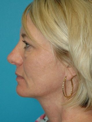 Before Image: Eye Lift (Blepharoplasty): Case 14 - left-side
