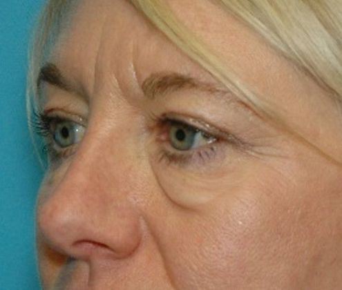 Before Image: Eye Lift (Blepharoplasty): Case 14 - left-front-oblique