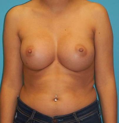 After Image: Breast Augmentation: Case 15 - front