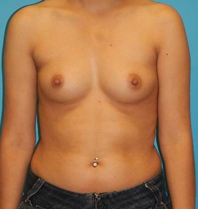 Before Image: Breast Augmentation: Case 15 - front