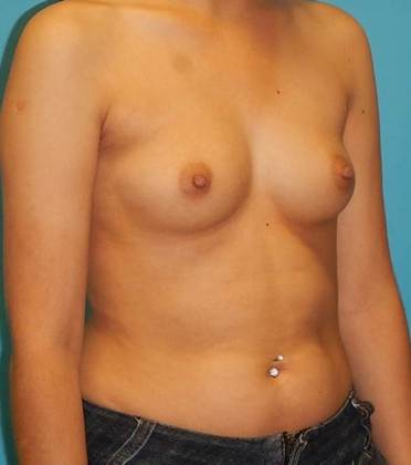 Before Image: Breast Augmentation: Case 15 - right-front-oblique