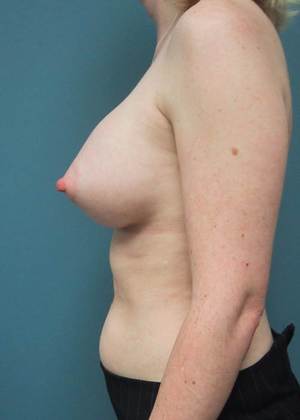 After Image: Breast Augmentation: Case 11 - left-side