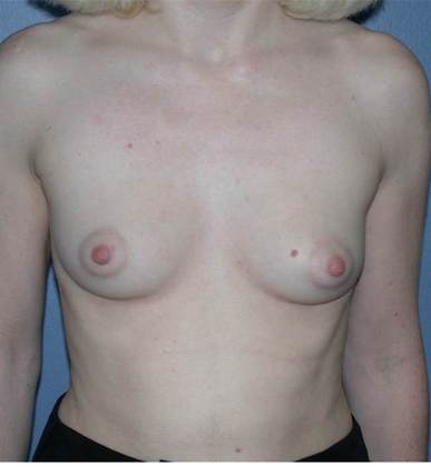 Before Image: Breast Augmentation: Case 11 - front