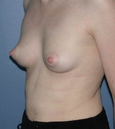Before Image: Breast Augmentation: Case 11 - left-front-oblique
