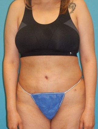 After Image: Abdominoplasty: Case 15 - front