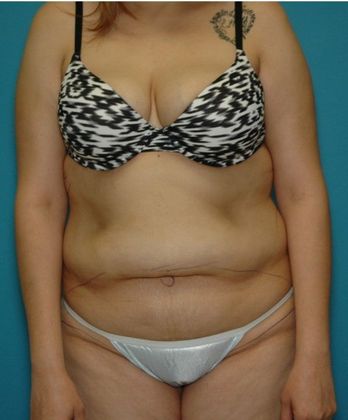 Before Image: Abdominoplasty: Case 15 - front