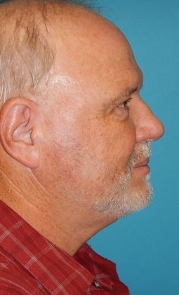 After Image: Eye Lift (Blepharoplasty): Case 15 - right-side
