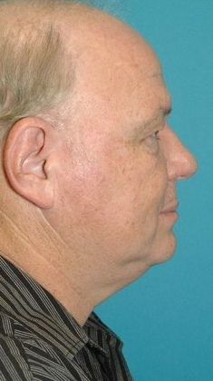 Before Image: Eye Lift (Blepharoplasty): Case 15 - right-side