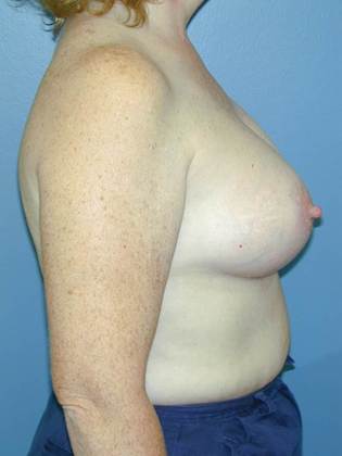 After Image: Breast Augmentation: Case 16 - right-side