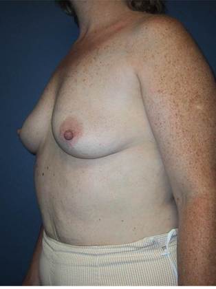 Before Image: Breast Augmentation: Case 16 - left-front-oblique