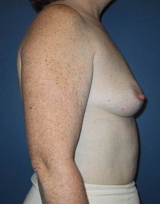 Before Image: Breast Augmentation: Case 16 - right-side