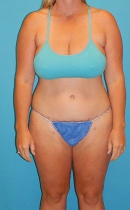 After Image: Abdominoplasty: Case 16 - front