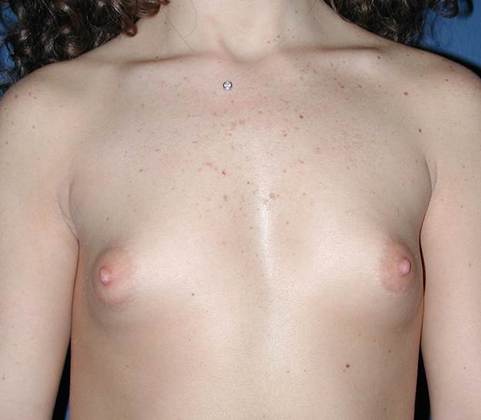 Before Image: Breast Augmentation: Case 17 - front