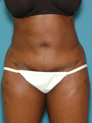 After Image: Abdominoplasty: Case 17 - front