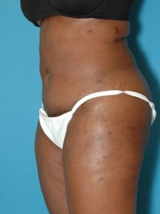 After Image: Abdominoplasty: Case 17 - left-front-oblique