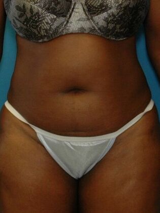 Before Image: Abdominoplasty: Case 17 - front