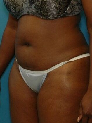 Before Image: Abdominoplasty: Case 17 - left-front-oblique