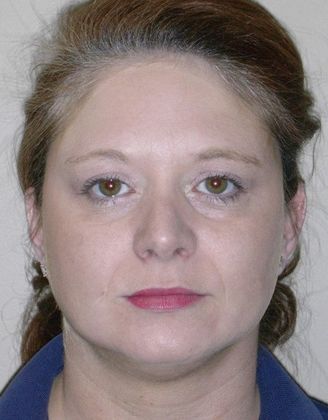 After Image: Botox® Cosmetic: Case 1 - front