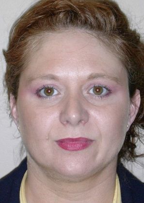 Before Image: Botox® Cosmetic: Case 1 - front