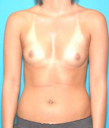 Before Image: Breast Augmentation: Case 18 - front