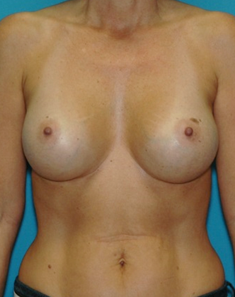 After Image: Breast Augmentation: Case 18 - front