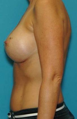 After Image: Breast Augmentation: Case 18 - left-side