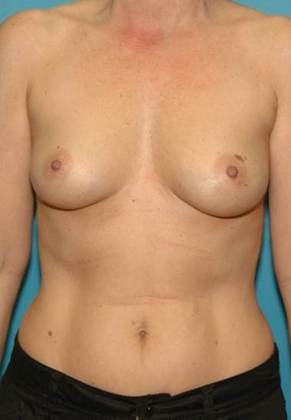 Before Image: Breast Augmentation: Case 18 - front