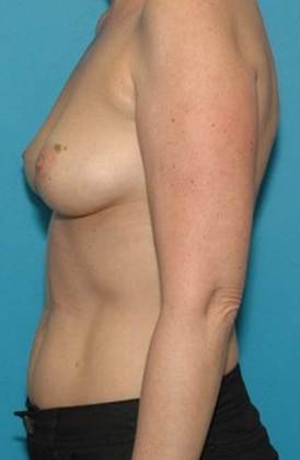 Before Image: Breast Augmentation: Case 18 - left-side