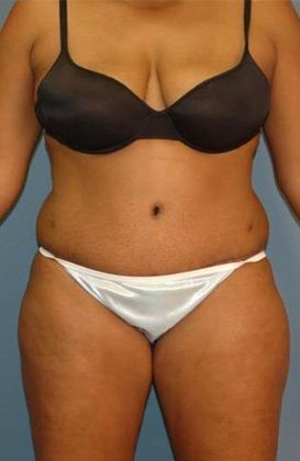 After Image: Abdominoplasty: Case 18 - front