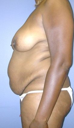 Before Image: Abdominoplasty: Case 18 - left-side