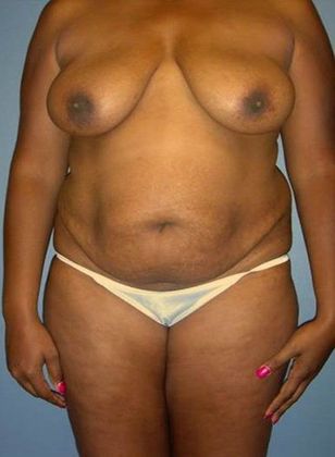 Before Image: Abdominoplasty: Case 18 - front