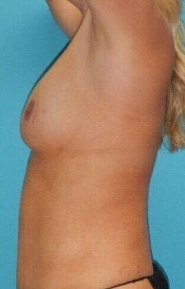 After Image: Fat Grafting Breasts: Case 1 - left-side