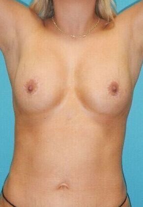 After Image: Fat Grafting Breasts: Case 1 - front