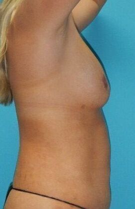 After Image: Fat Grafting Breasts: Case 1 - right-side