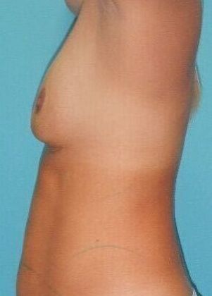 Before Image: Fat Grafting Breasts: Case 1 - left-side