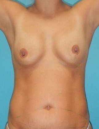 Before Image: Fat Grafting Breasts: Case 1 - front