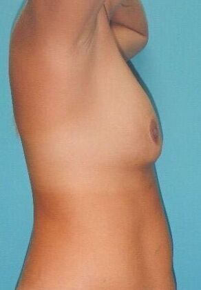 Before Image: Fat Grafting Breasts: Case 1 - right-side