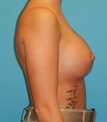 After Image: Breast Augmentation: Case 19 - right-side