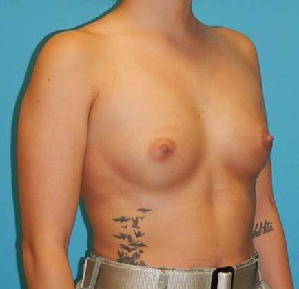 Before Image: Breast Augmentation: Case 19 - right-front-oblique