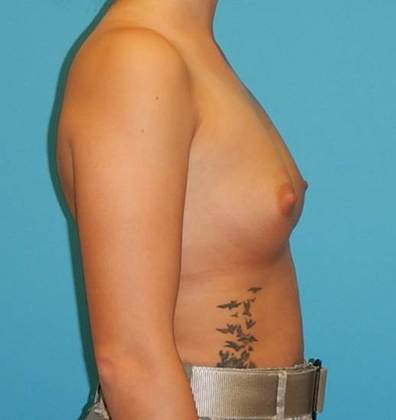 Before Image: Breast Augmentation: Case 19 - right-side