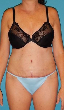 After Image: Abdominoplasty: Case 19 - front