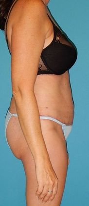 After Image: Abdominoplasty: Case 19 - right-side